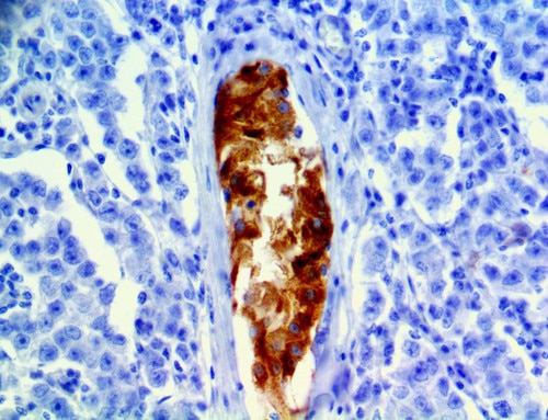 IHC of Inhibin Alpha on a FFPE Testicular Cancer Tissue